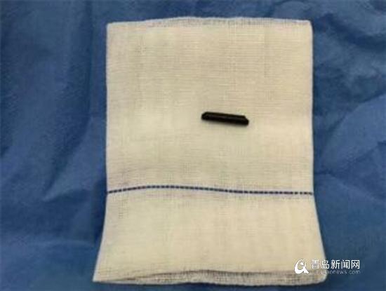 醫(yī)生從男子手掌中取出折斷的筷子,約2cm長(zhǎng)。