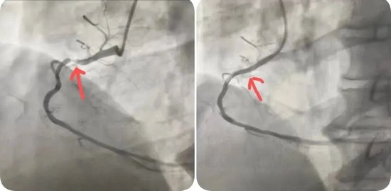 图一：溶栓再通，有狭窄 &nbsp;图二：置入支架后狭窄解除