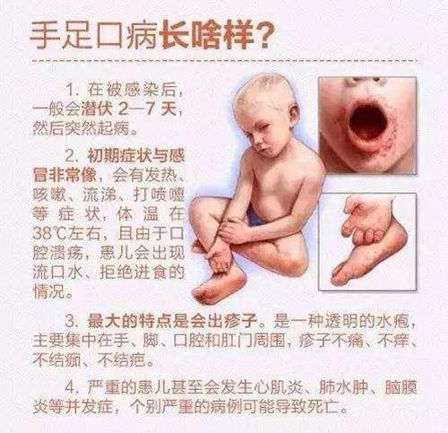 手足口病患兒癥狀多以以下態勢發展: