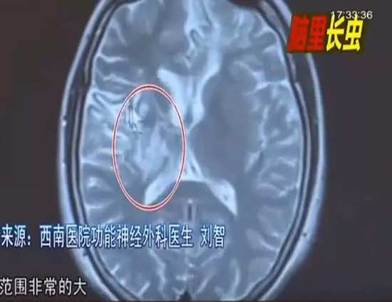 她當時來醫(yī)院就診的時候，主要是一側(cè)肢體無力和癲癇。經(jīng)過檢查，在小廖的大腦內(nèi)發(fā)現(xiàn)了問題。