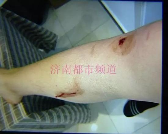(薛女士受伤的腿)