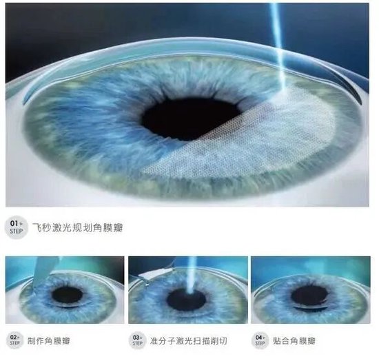 飞秒激光近视手术