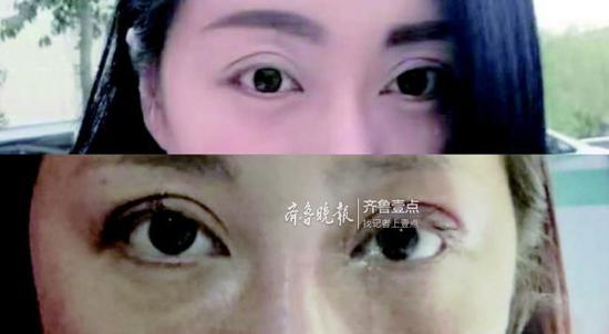 解女士提供的今年1月雙眼皮重瞼修復術前后對比圖。受訪者供圖
