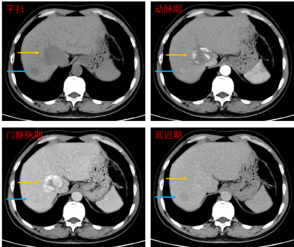 （某患者腹部平扫CT示两处低密度病灶，增强扫描确诊大病灶为良性血管瘤（黄箭），小病灶为肝癌（蓝箭）。）
