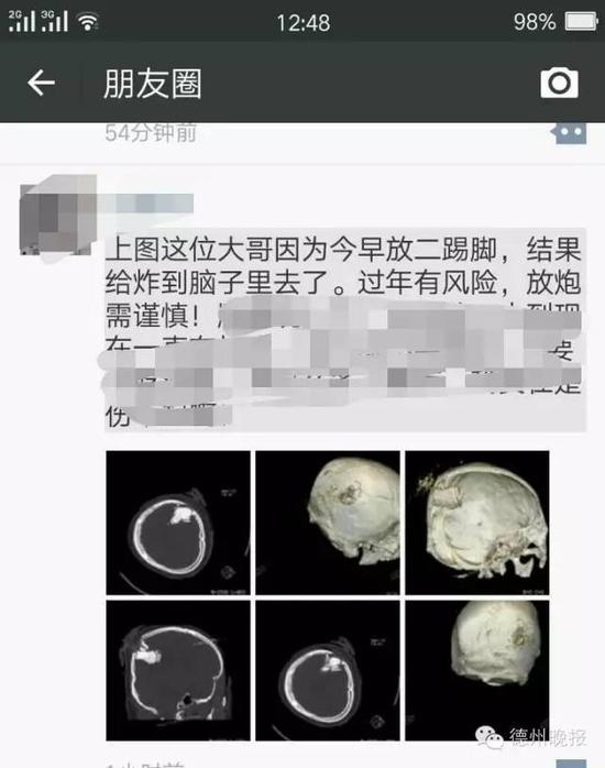 德州一男子被炸破眼球