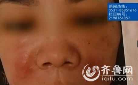 女孩整形后脸部右侧经常疼痛抽搐，存在坏死的迹象。（视频截图）
