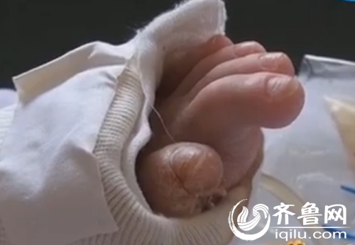 男孩的脚曾经被自己拿剪刀剪过,却毫无痛感。(视频截图)