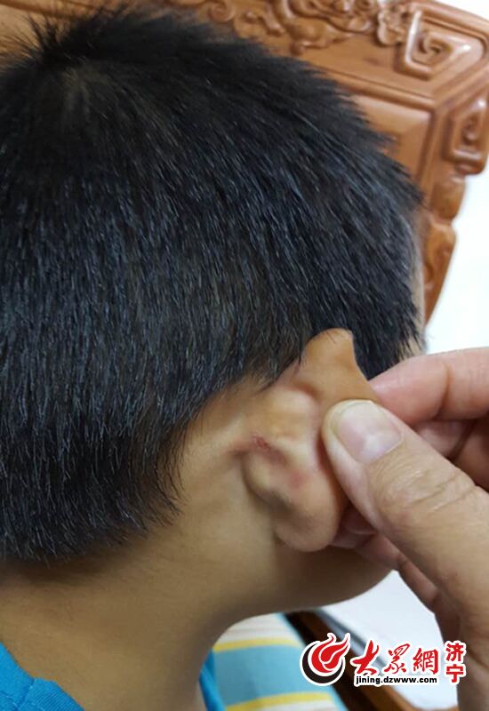 孩子在校期间出现过耳朵撕裂