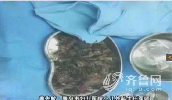 醫生通過手術從一名五歲小姑娘的胃里取出了一些密密麻麻的黑色物體