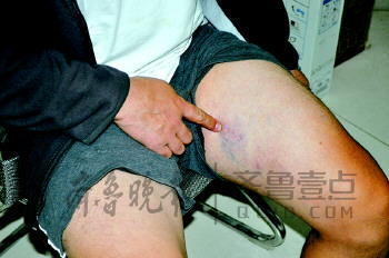 賀某身上被打出淤青。