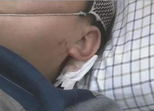 和張大哥一起被打的,還有躺在旁邊病床上的周大哥。經過醫生初步判斷,周大哥左額部皮下軟組織略腫脹,一直是在昏迷狀態。目前還沒有度過危險期。
