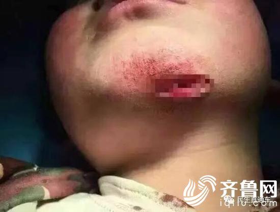 臨沂八歲男童遭繼母虐待,下巴上有塊5公分左右的傷疤。