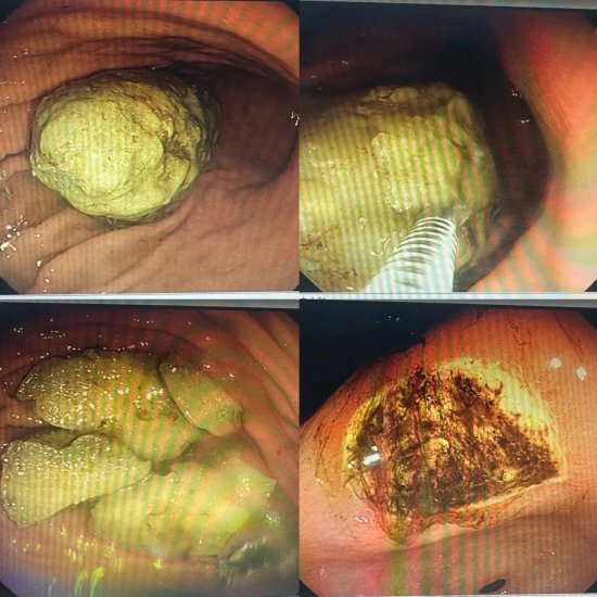 胃镜下的胃石影像