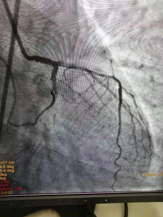 二次PCI术后图