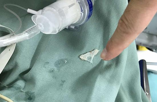 婴儿吞2cm鱼骨后在沪取出 医生:最近取出东西
