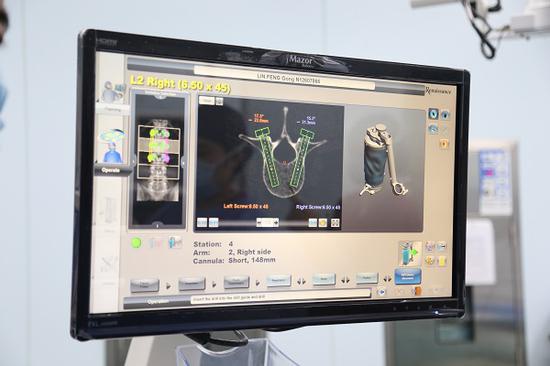 图说：市一医院完成沪上首例首台MAZOR机器人辅助下脊柱肿瘤切除术 来源/采访对象提供