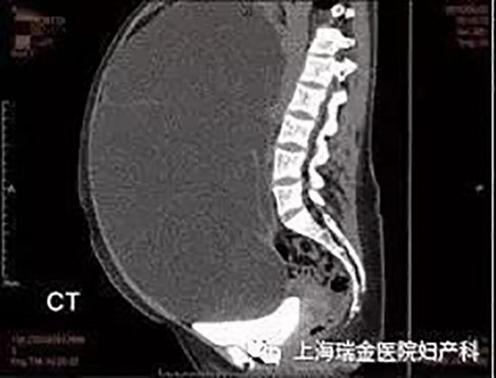 小伍的腹部CT。 本文图片均由上海瑞金医院 供图
