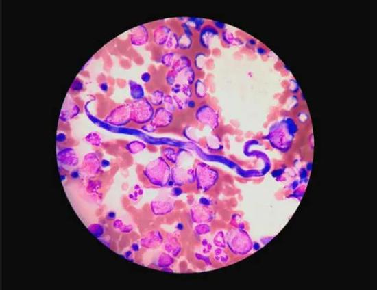 在检验科主任王剑飙的技术支持下,终于在骨髓涂片中发现了数量极少的寄生虫微丝蚴。瑞金医院 提供