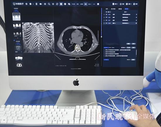 图说：依图AI读片技术 新民晚报记者 陈梦泽 摄