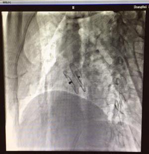 图为房缺封堵术后封堵伞装置