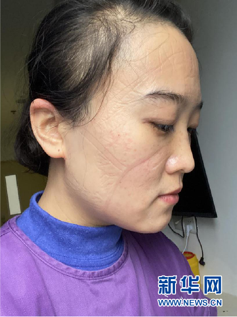 经过一天的“战斗”,去掉防护装置,李华的脸上有不少勒痕。(受访者供图)新华网 发