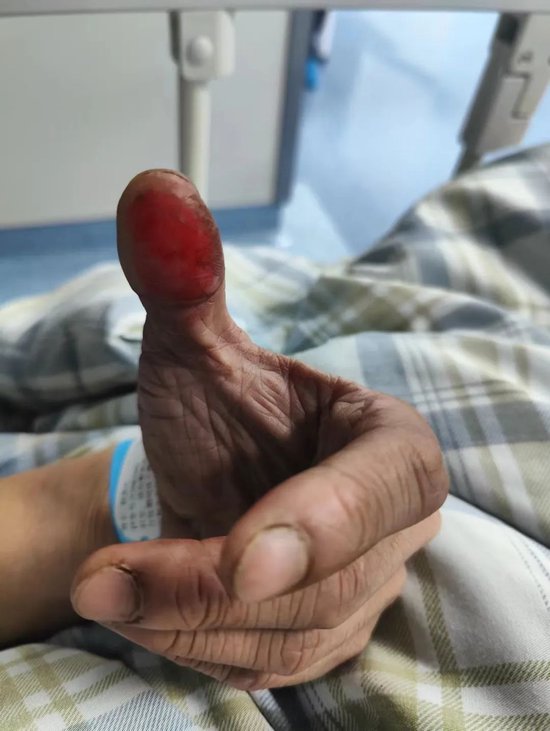 图为陈凯松救火时被烫伤的手指