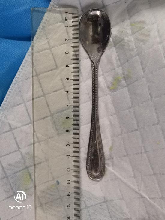 吞进体内的勺子长约 13 厘米