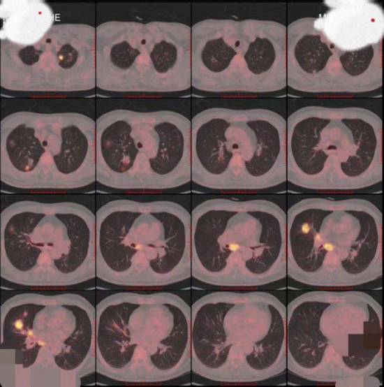 肺癌诊断的pet/ct融合图像