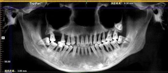 90后姑娘上半口牙全松动被拔光 轻度牙周炎6年