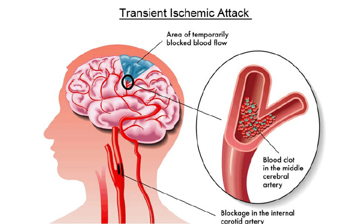 什么是动脉粥样硬化 f4fa-iwtqvyk3609205.jpg