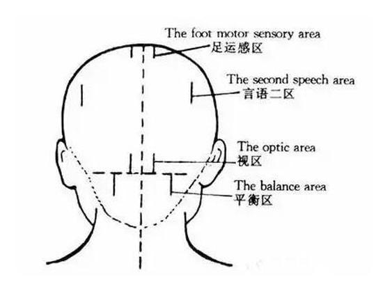 针灸技术丨头皮针操作细则