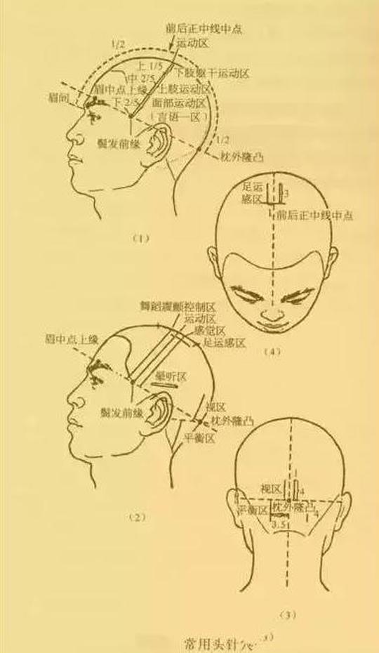 针灸技术丨头皮针操作细则