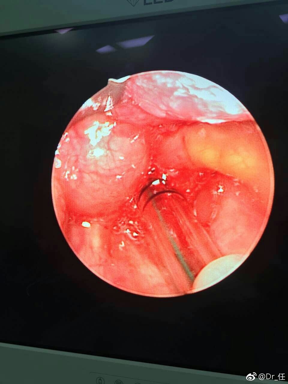 新生儿喉喘鸣也可能是会厌囊肿惹的祸|新生儿