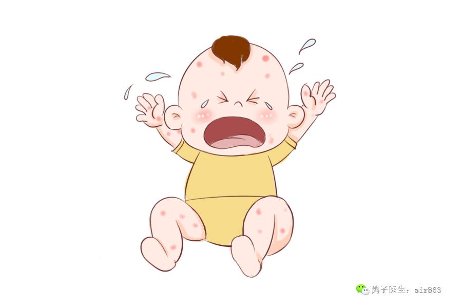 夏季由于温度较高,容易出汗,而且空气也比较湿润,是宝宝湿疹的高发季,宝宝的尿布区域经常会出现红肿、红色小颗粒,宝宝还容易哭闹、有烦躁情绪。妈妈护理起来,难度增大。 湿疹常发于婴幼儿身上,多见于面颊、额头、两耳根、四肢、臀部、私处等位置,初发时,通常表现为发散或者集中区域性的小丘疹或者红斑,如果没有及时处理,还会逐渐增多,并可见小水泡、黄白色鳞屑及痂皮,后期会有白色粘液渗出,挠抓就容易出现糜烂及继发性感染。但是好在湿疹病发在表皮,愈合后一般不会留下疤痕。 容易患湿疹的孩子皮肤本就比较敏感,夏季