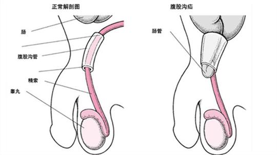 宝宝疝气的症状及是否能用疝气带?|疝气带|宝宝