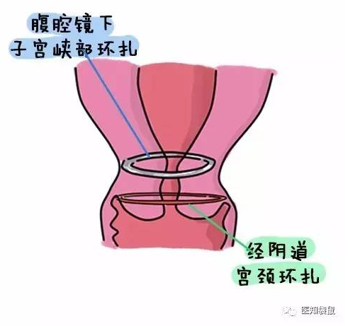准妈妈有早产征兆该如何保胎?这种情况需要尽