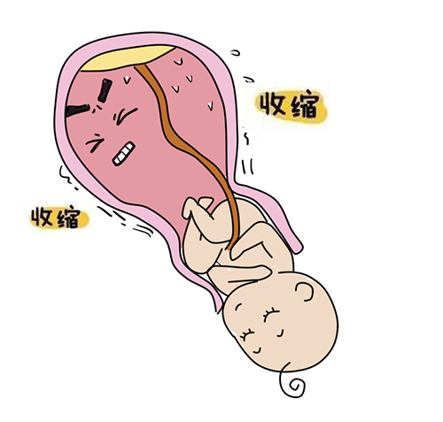 征兆该如何保胎?这种情况需要尽早手术|宫颈|机