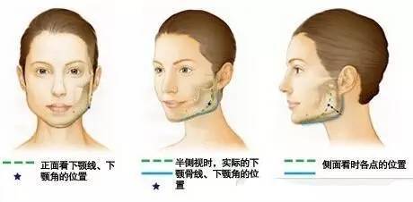 下颌角手术中大出血,看资深整形医生如何应对