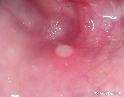 警惕疱疹性咽峡炎,看起来像感冒,孩子却难熬!