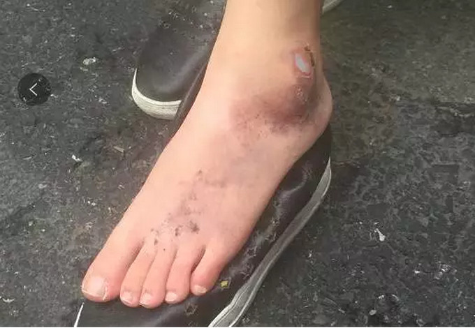 "的一声,原来,小张的左脚绞进了自行车车轮里.
