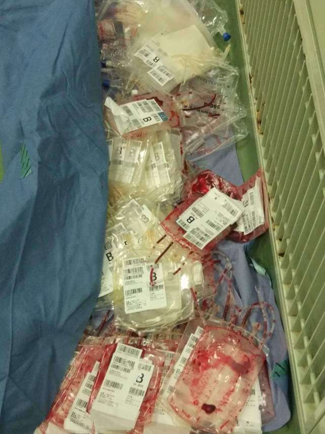 45岁产妇分娩二胎遭遇大出血,9小时抢救母婴平安