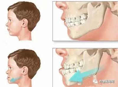 二、乳牙过早脱落或滞留均可导致牙齿长得不齐