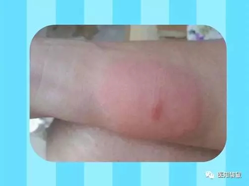 宝宝被蚊虫叮咬后,抹什么能快速止痒?|水痘|皮