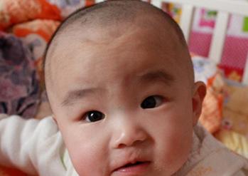 宝宝囟门凹陷宝妈以为正常,去医院检查后的结