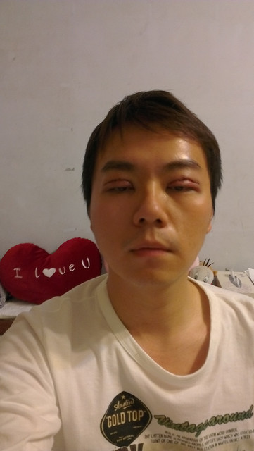 男士割双眼皮手术后变身大眼型男