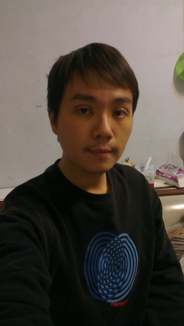 男士割双眼皮手术后变身大眼型男