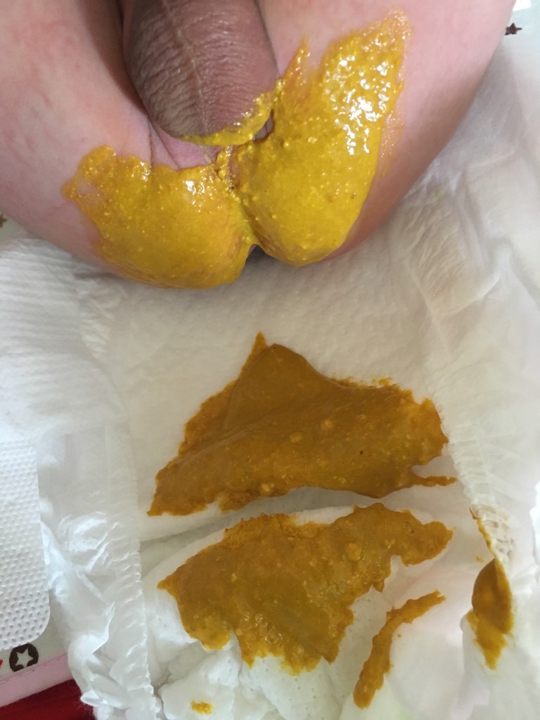 如何通过大便正确判断宝宝健康状态