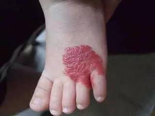 姚明女儿胎记遭热议, 那么胎记是怎么形成的能