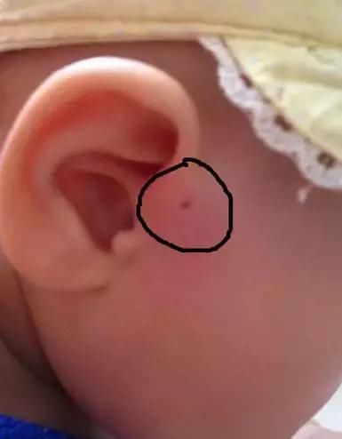 你家宝宝耳边有这种小孔吗?真相才不是富贵命