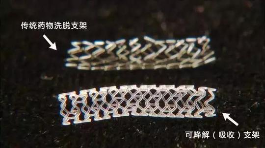 生物可降解(吸收)支架,一种由聚乳酸等可降解被人体吸收的材料制成
